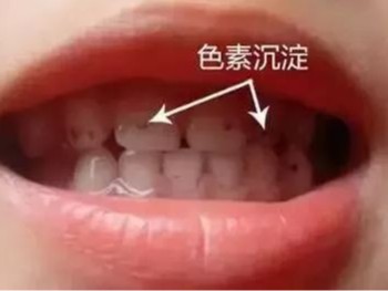 小朋友牙齿上的黑色素能去掉吗？